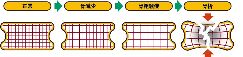 骨折までの流れ