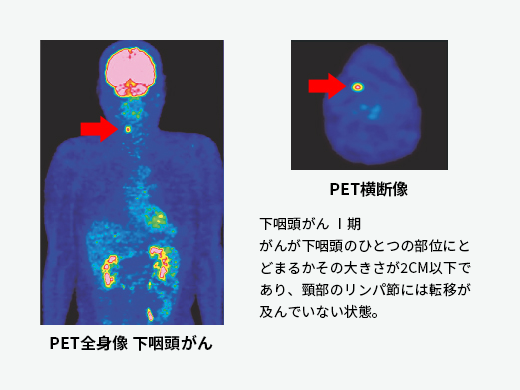 PET全身像のイメージ